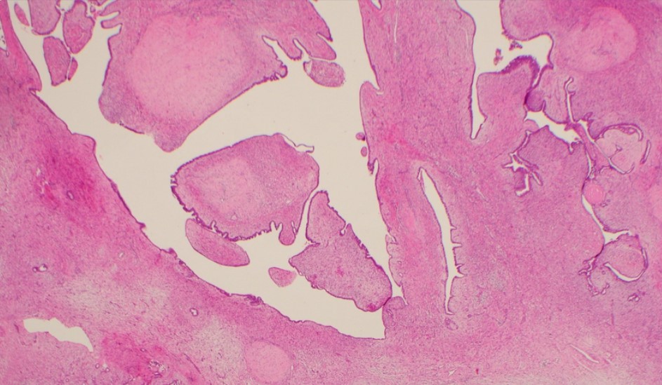 Meet Sandra O’Toole - Breast Cancer Researcher and Pathologist 1 Breast cancer cells that are pink under microscope.